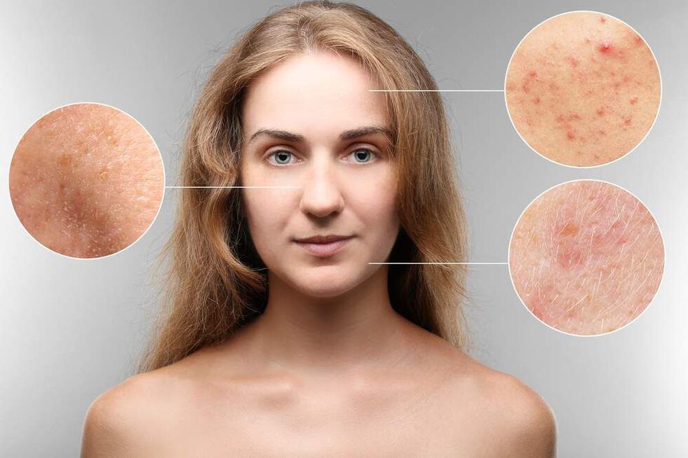 facial rashes due to parasites